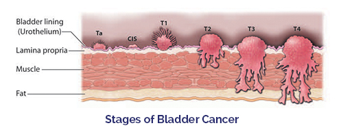 stage of Bladder Cancer